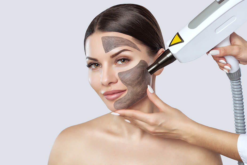 carbon laser peel