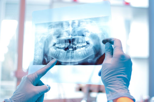 What are the factors that you need to consider in having a full mouth rehabilitation?