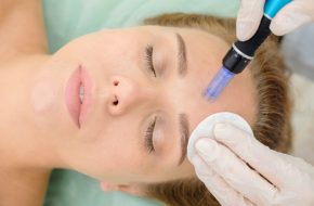 What You Have to Know about Skin Needling