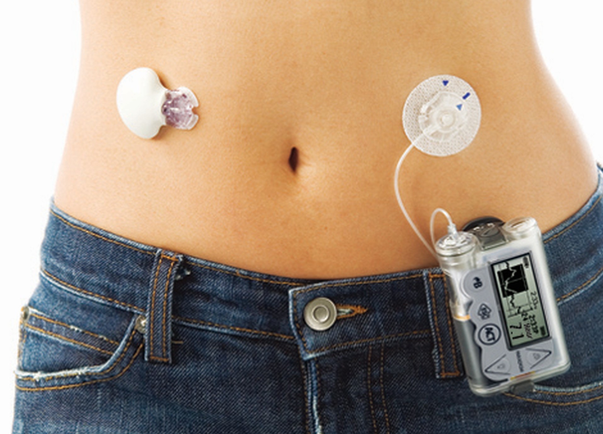 The Benefits And Disadvantages Of Using CGM Patches