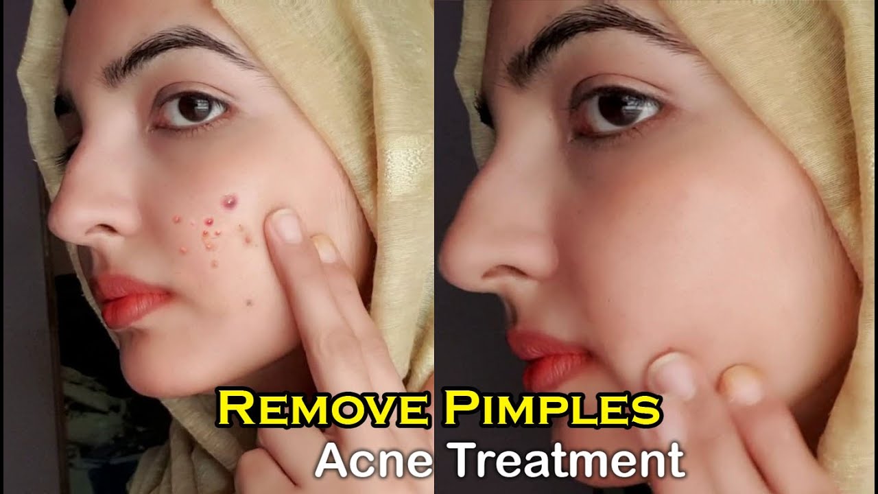 Pills for Effective Acne Treatment without Side Effects